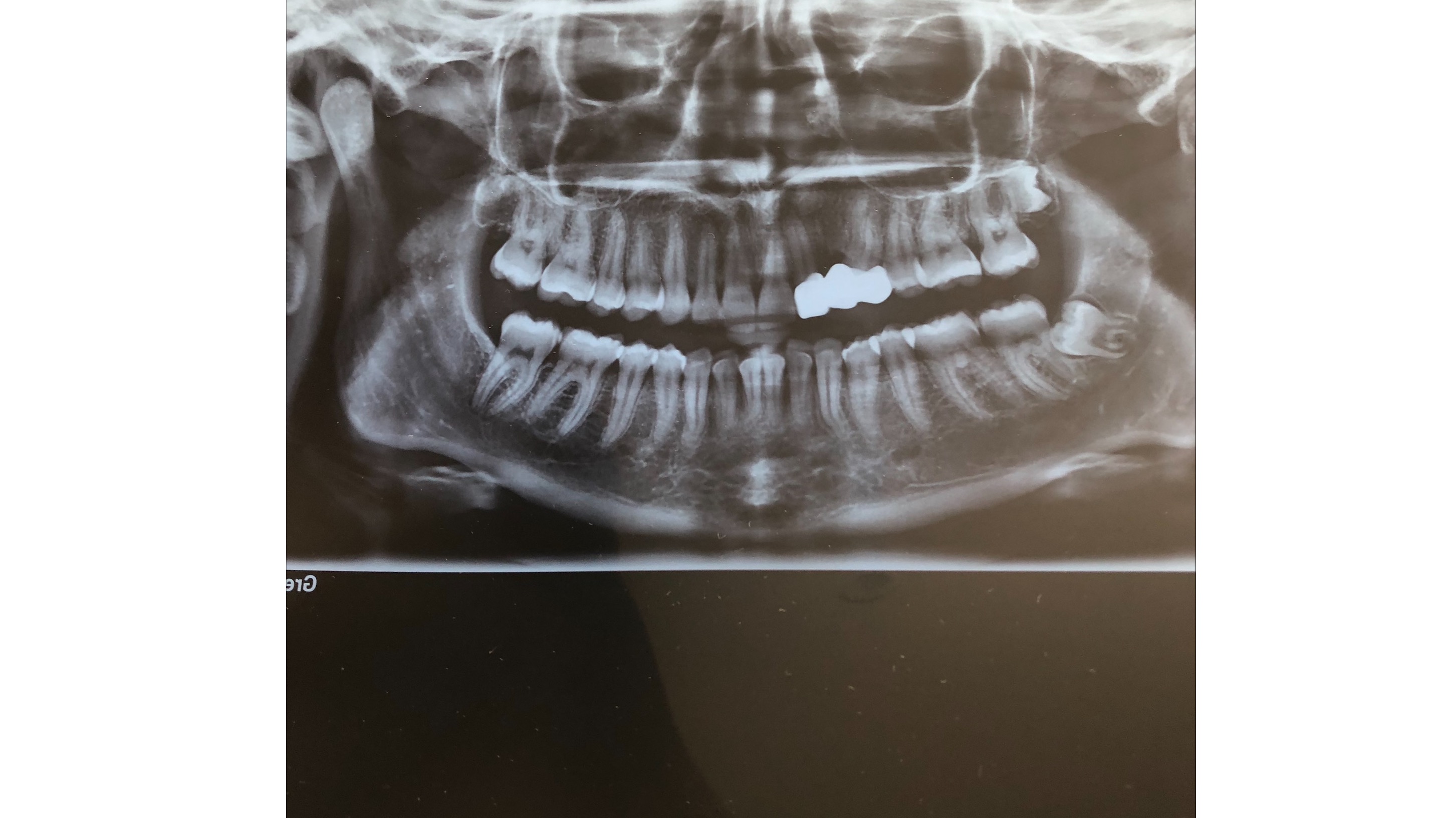 double-jaw-surgery-timeline-day-1-30-one-video-each-day-before