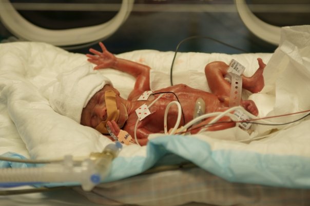Rpa Nicu Help Premature Babies Live